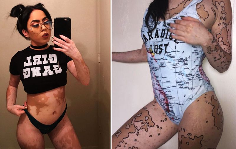 After being bullied for years, this woman turns her vitiligo skin into body art