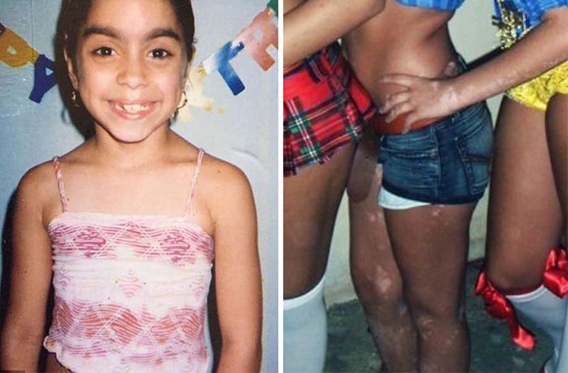 Ashley Soto vitiligo body art-1