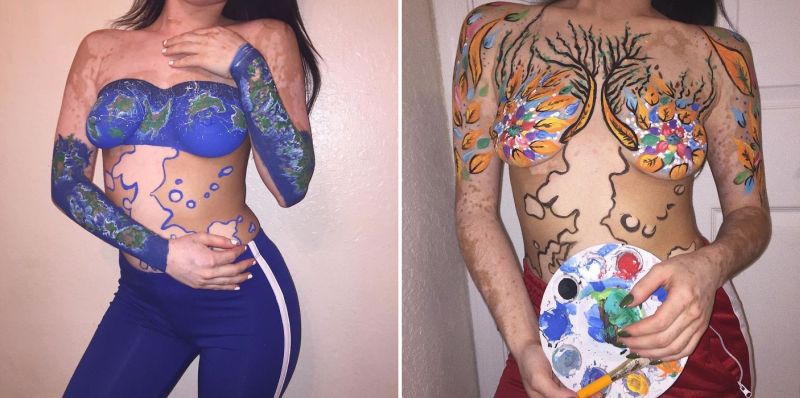 Ashley Soto vitiligo body art-2