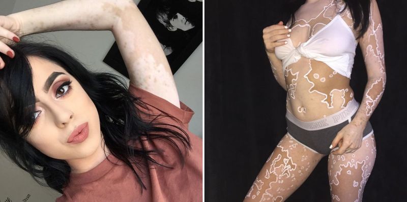 Ashley Soto vitiligo body art-3